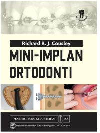 Mini-Implan Ortodonti
